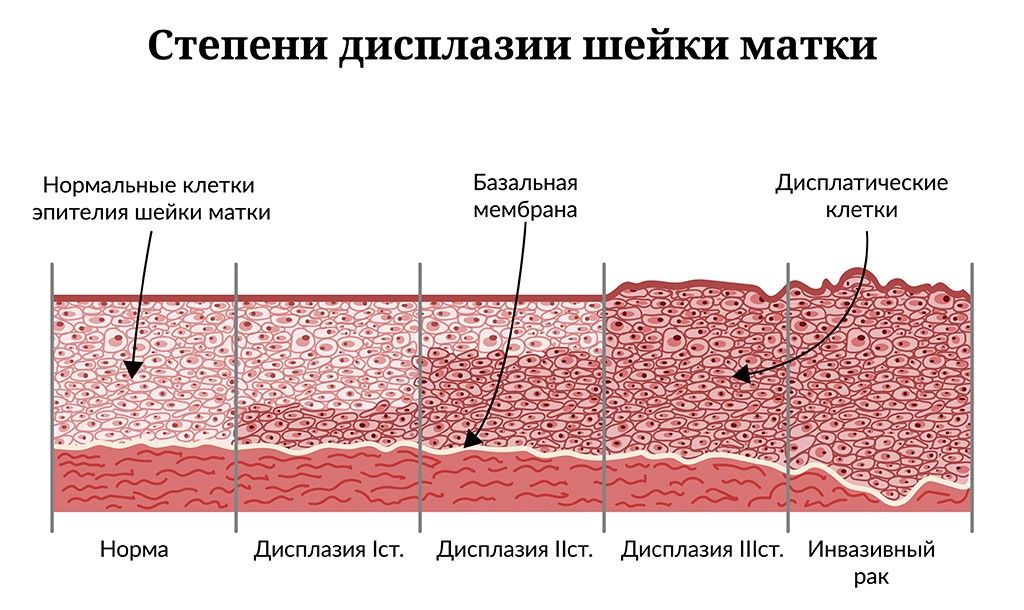 Стадии дисплазии шейки матки