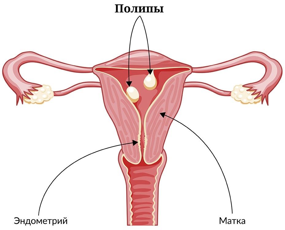 Причины тонкого эндометрия у женщины