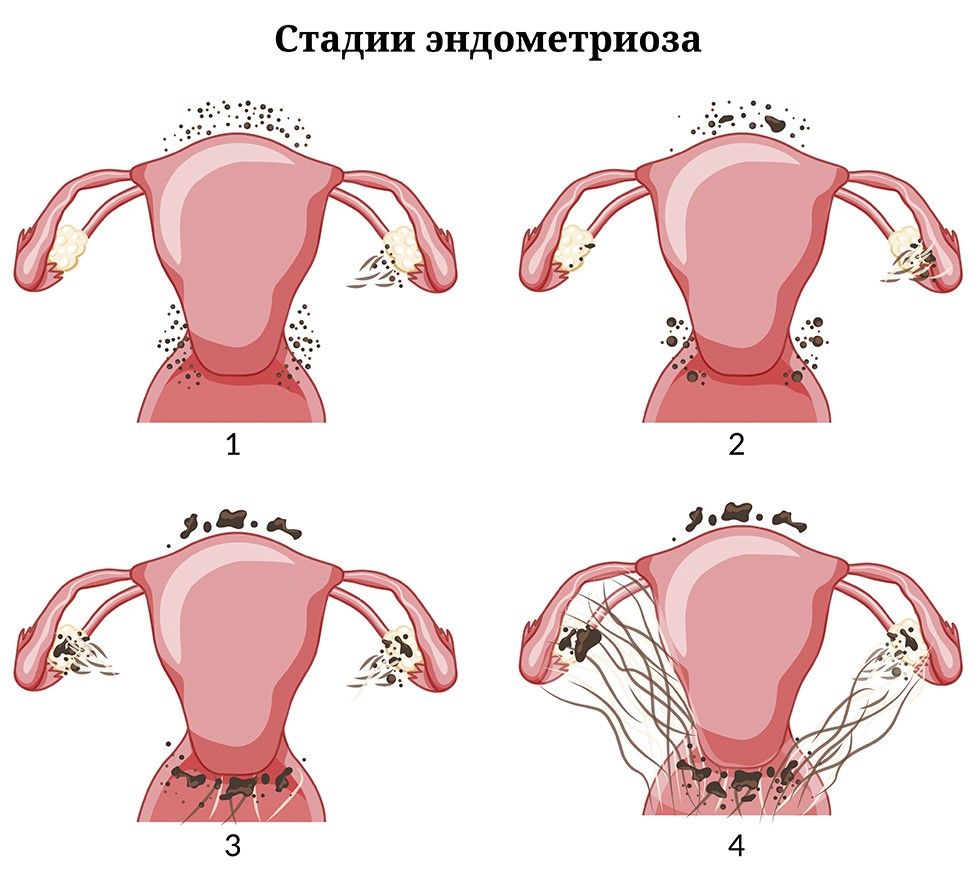 Препараты для лечения эндометриоза. Визанна при эндометриозе | Клиника «Центр ЭКО» в Калининграде