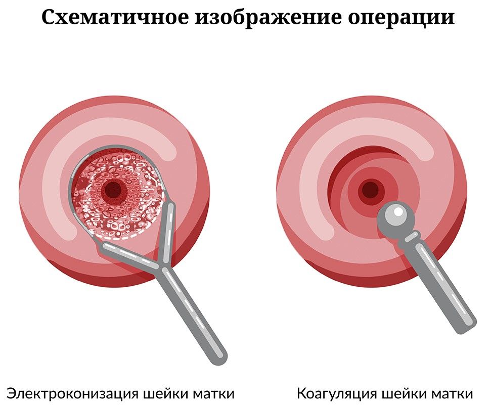 Конизация шейки матки