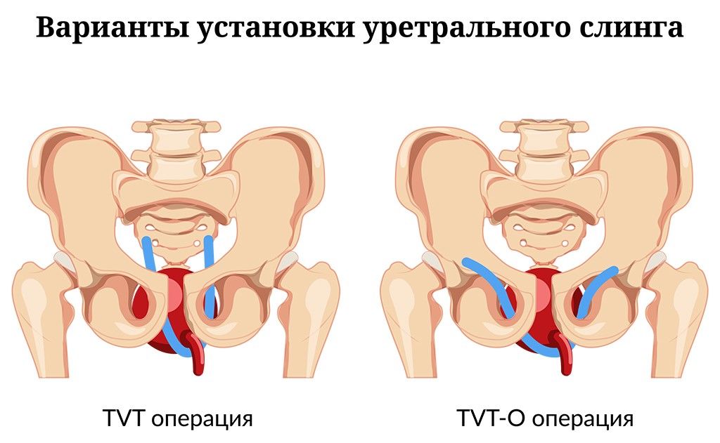 TVT операция